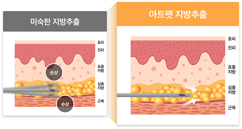 시술 전후 비교 2